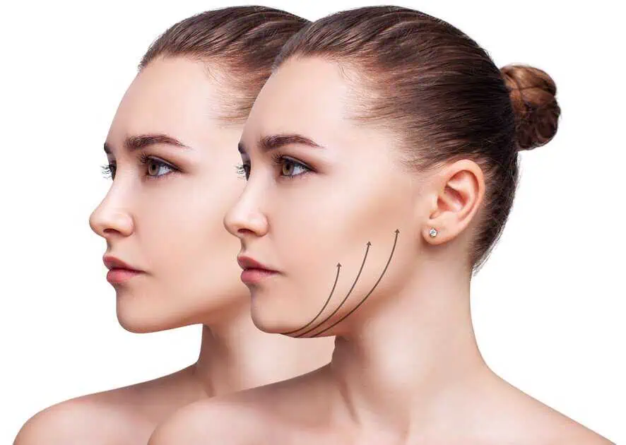 PCDC And Kybella in Hershey, PA by Spruce Medical Aesthetics