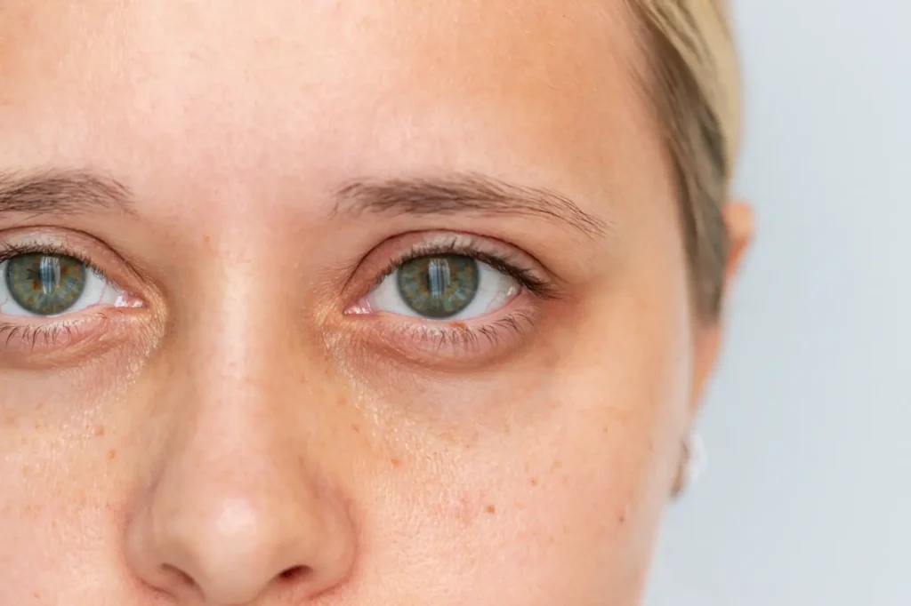 Close-up of a person's eyes and under-eye area showing visible shadows beneath the eyes.