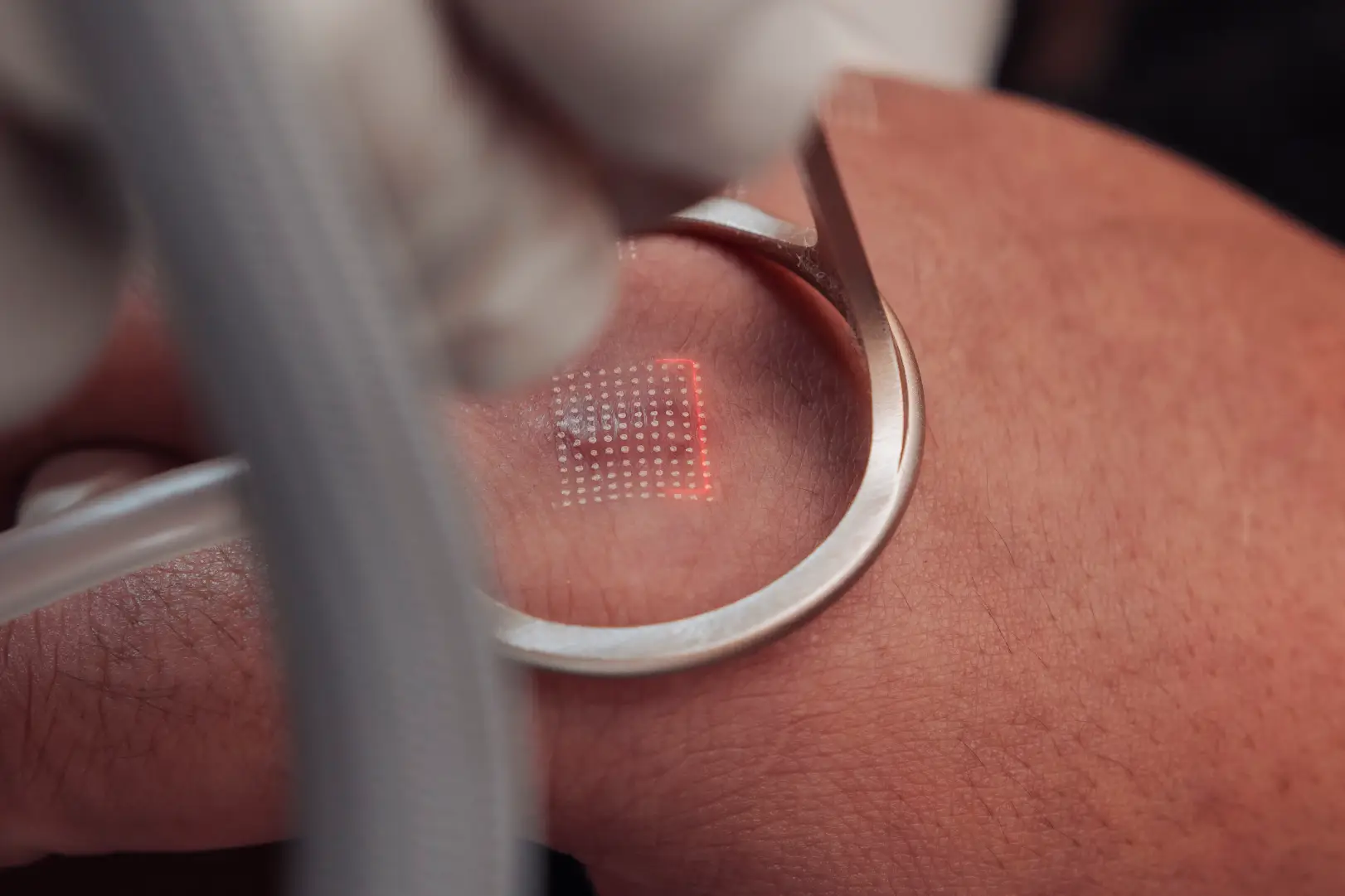 Close-up of a laser device projecting a grid of small dots onto a person's skin.